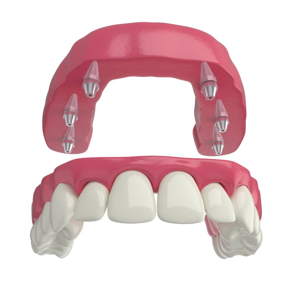 Dental Implants in Dubai