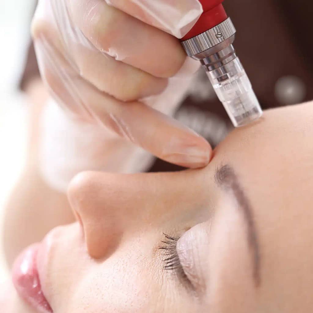 What is Microneedling?