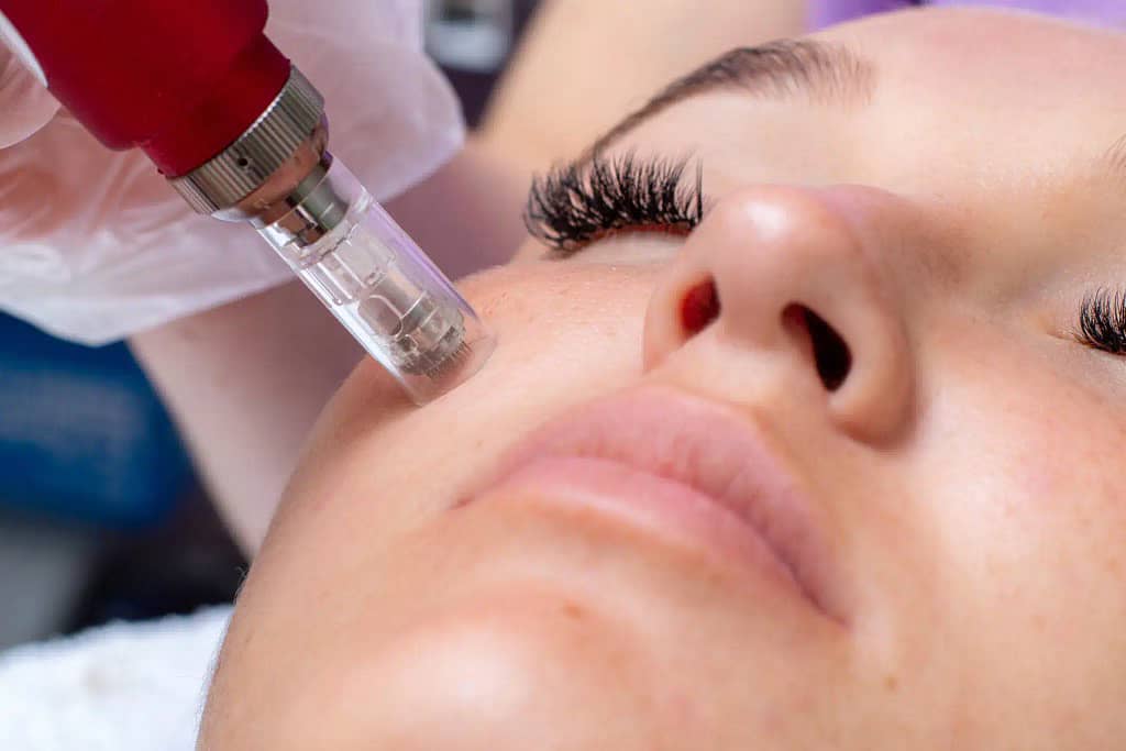 What is Microneedling?