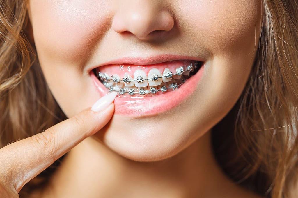 Dental Braces