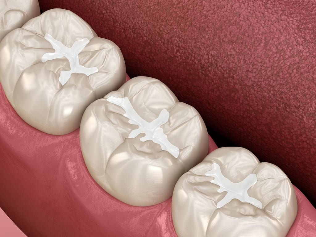 Best veneers in Dubai