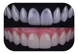 Emax Veneers