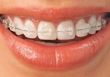 Dental Braces