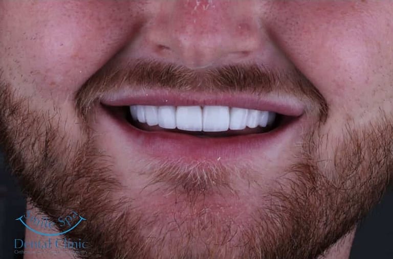 Emax Veneers