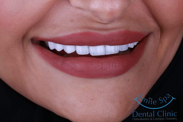 Emax Veneers