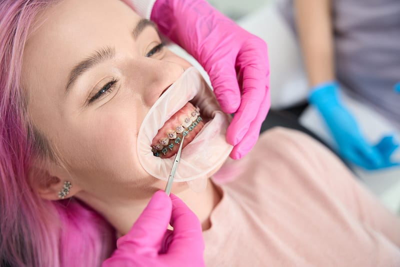 Orthodontic Braces