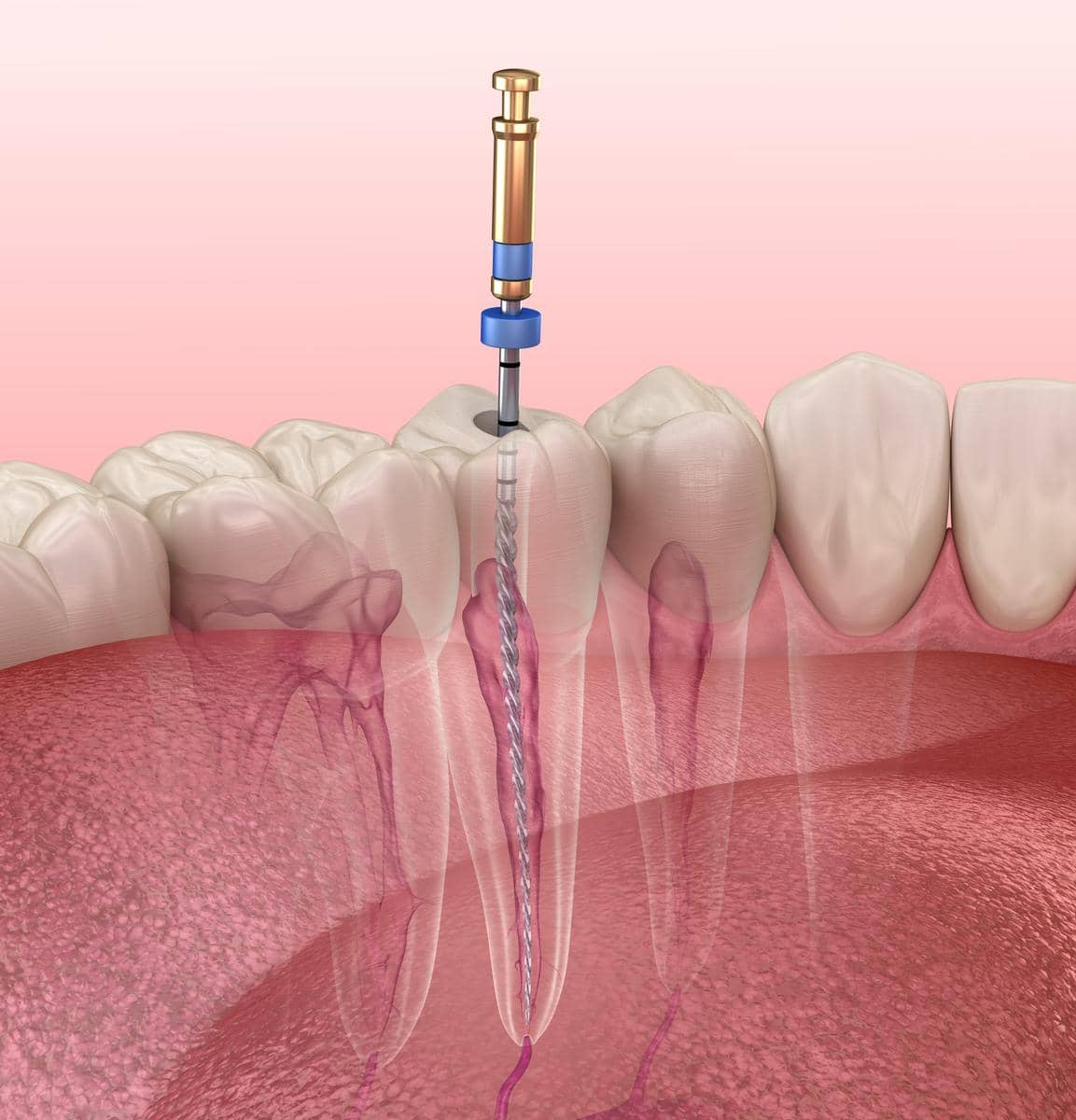 Root Canal Treatment