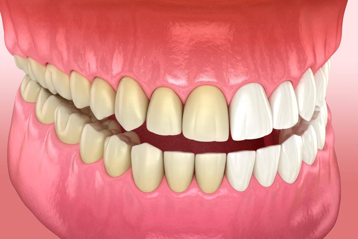 Teeth whitening