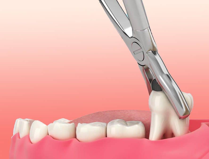 Tooth Extraction