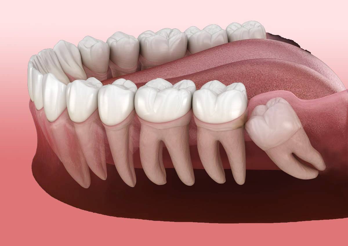 Wisdom Tooth Extraction
