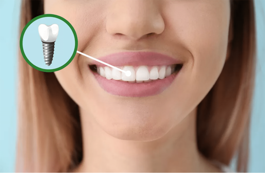 Dental Implant Procedures
