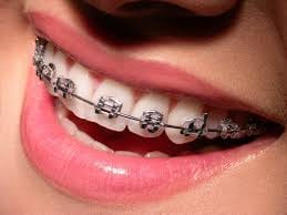 Benefits of orthodontics